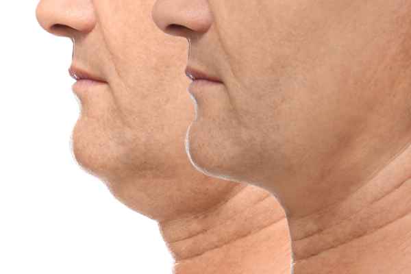 HIFU - Breakthrough in Anti - ageing 2 hifu results Buckingham