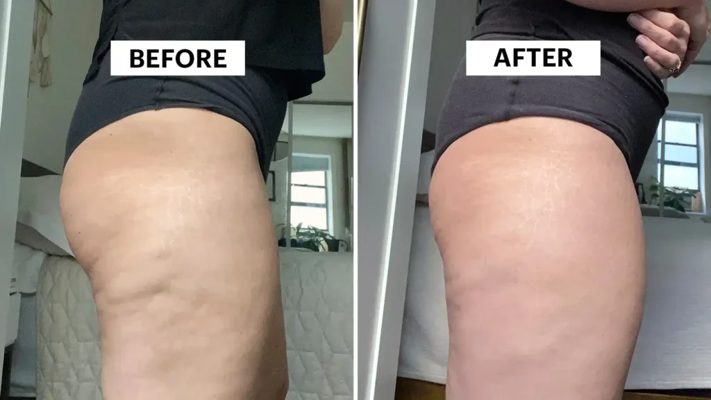 Sculpting Your Bum: Can Toning Exercises Really Reduce Cellulite? 1 Do Toning Exercise Buckingham Really Tackle Cellulite?