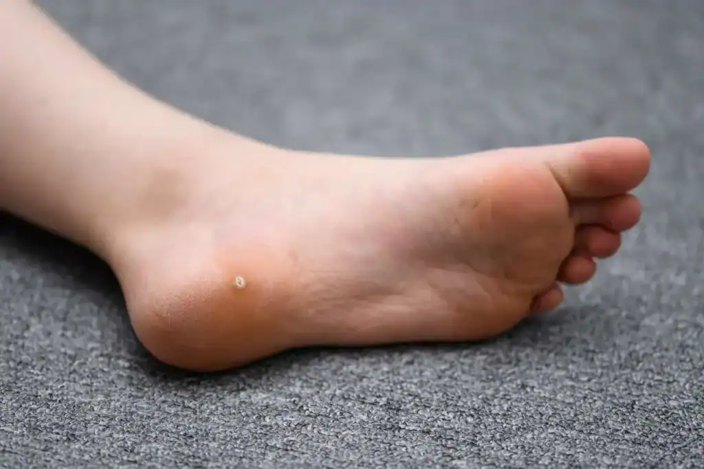 Cryotherapy For Warts And Also Verrucas 2 Image of verruca on the bottom of the foot that able to be treated with Cryotherapy Buckingham