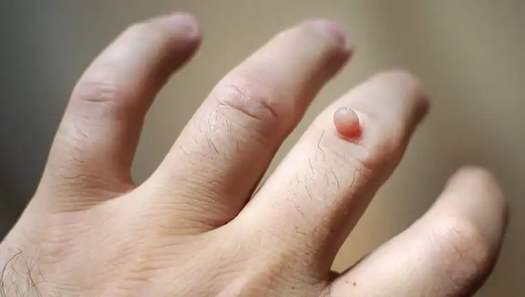 Image of blemish that Cryotherapy Buckingham can remove with Lipo 360.