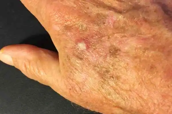 Image of Actinic keratoses Buckingham on a person hand