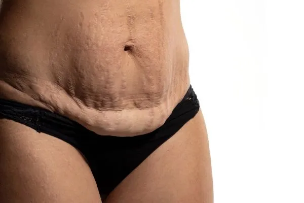 The science behind skin tightening Buckingham picture of a woman's sagging skin on the stomach